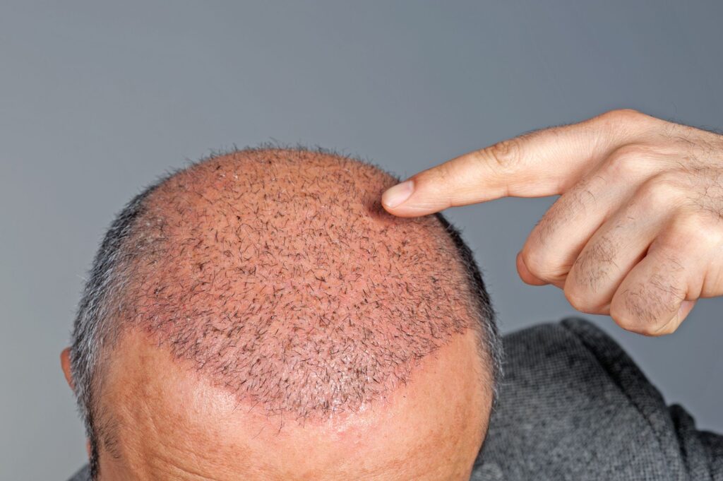 Tailoring Your Hair Transplant Journey: Finding the Best in the UK