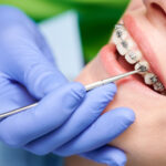 The Ultimate Guide to Modern Dental Alignment and Confidence