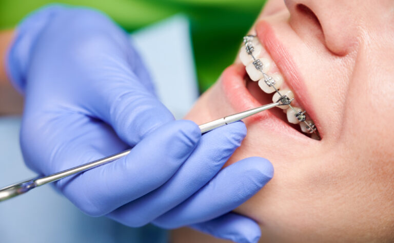 The Ultimate Guide to Modern Dental Alignment and Confidence