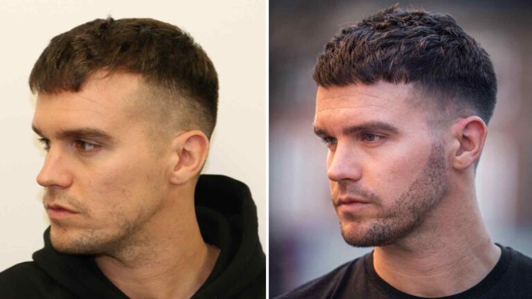 A Fuller Look: The Growing Demand for Beard and Eyebrow Hair Transplant UK Services