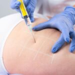 Permanent Cellulite Treatment Explained: The Role of Subcision