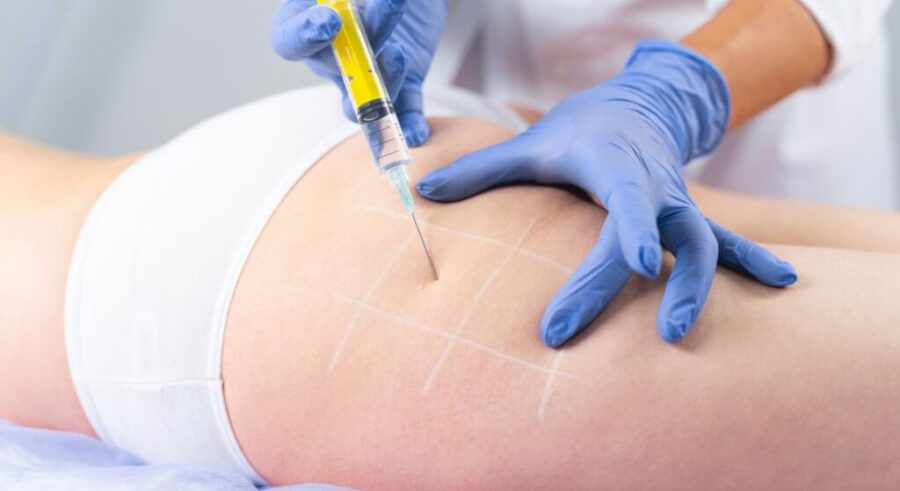 Permanent Cellulite Treatment Explained: The Role of Subcision