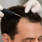 Why Patients Travel From Around the World for Harley Street Hair Transplants